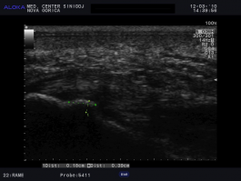 Ultrazvok pete - trn petnice, spina calcanea, indikacija ESWT